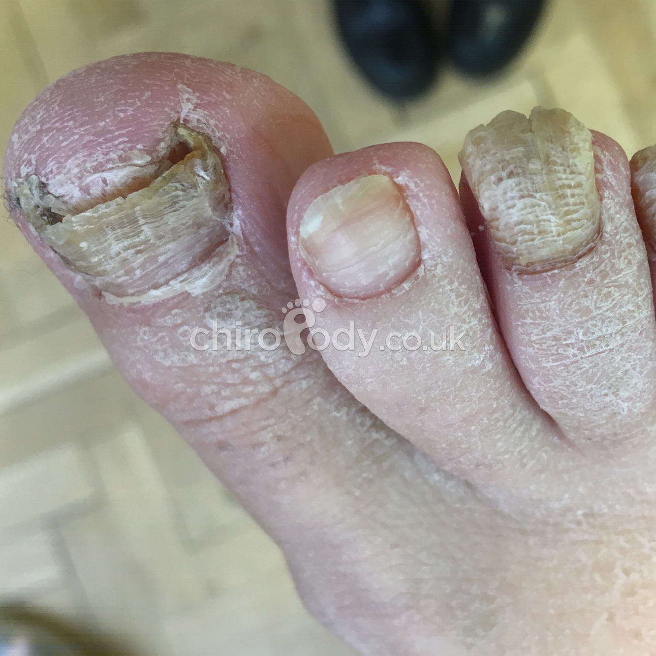 Toenail Reconstruction Services Manchester Podiatry Leading Podiatry Provider In Manchester