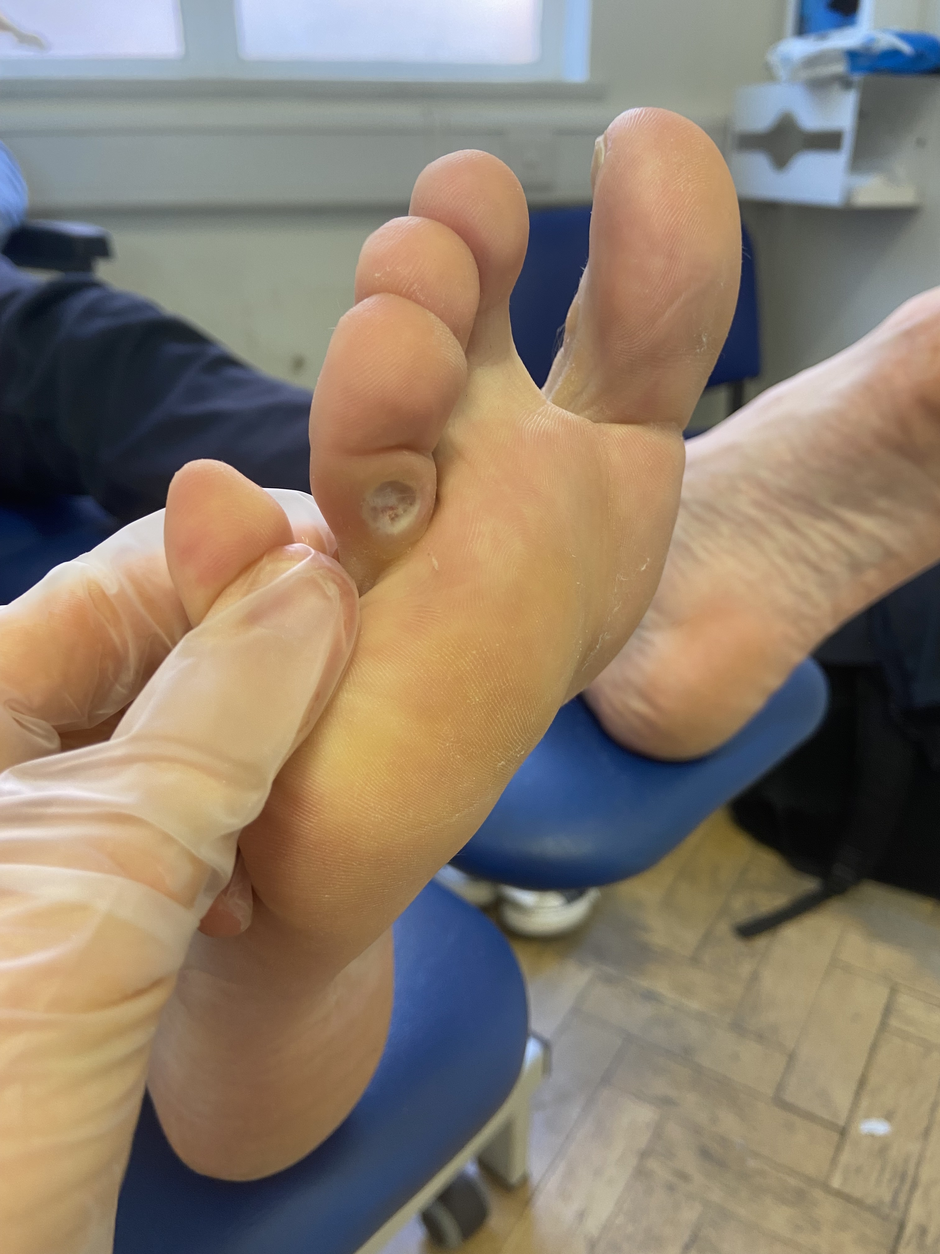 https://www.manchesterpodiatry.co.uk/images/content/before-and-after/corns/11b.jpg