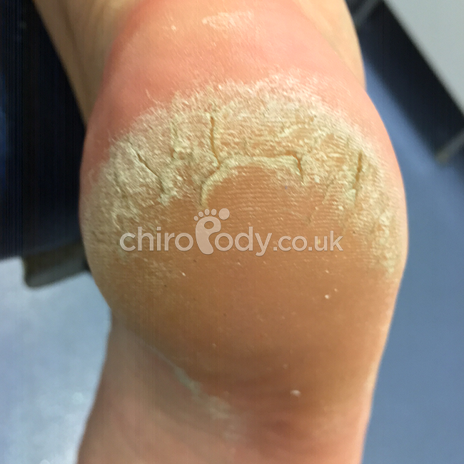 Skin Conditions/Foot/Heel - Relieve Foot Pain & Leg Pain