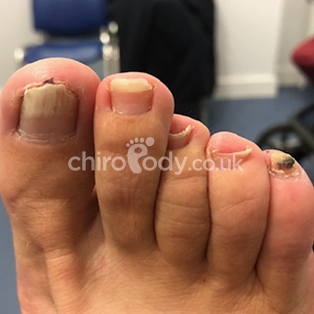 Fungal Nail Infection | Onychomycosis | Este Medical Group