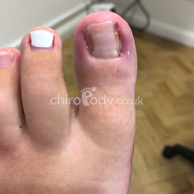 Toenail Surgery FAQs